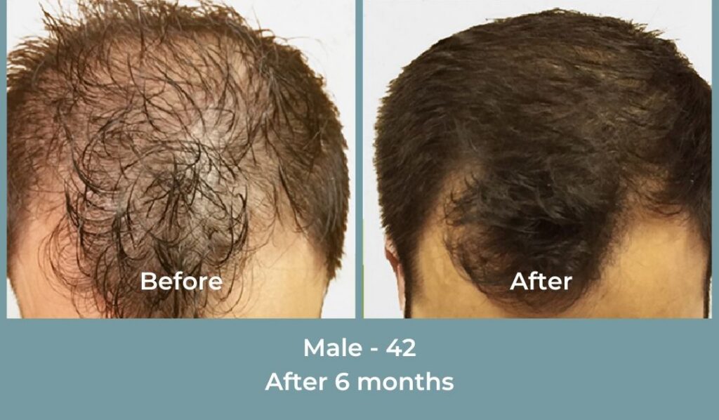 Facebook Ads 1080x1080 GetHairMd - 87