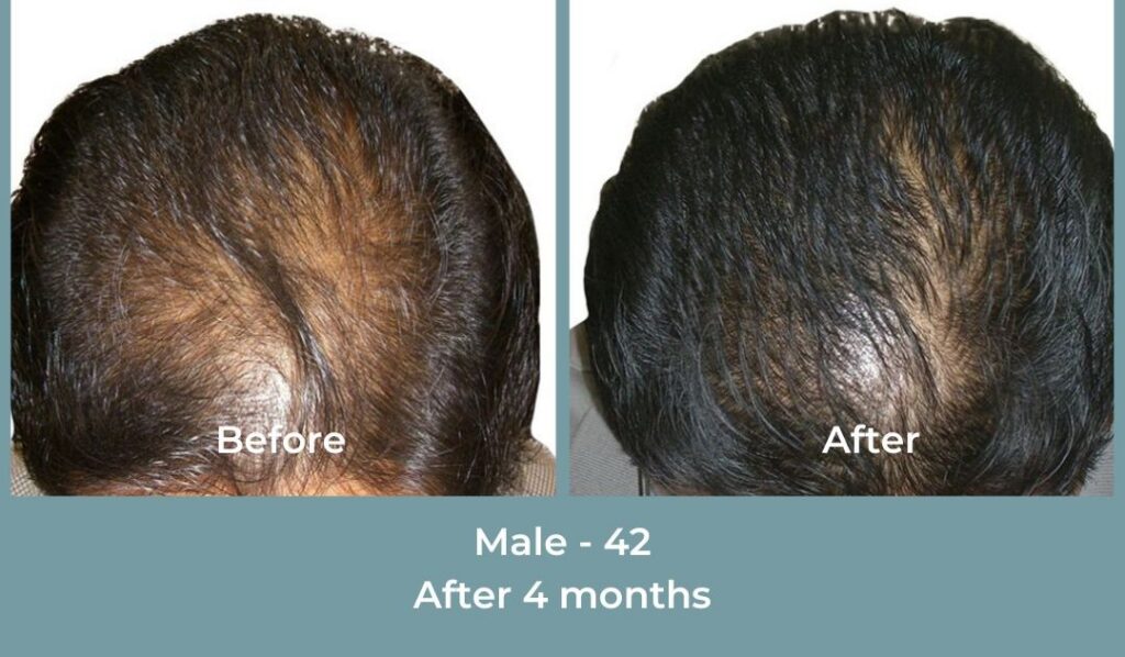 Facebook Ads 1080x1080 GetHairMd - 86