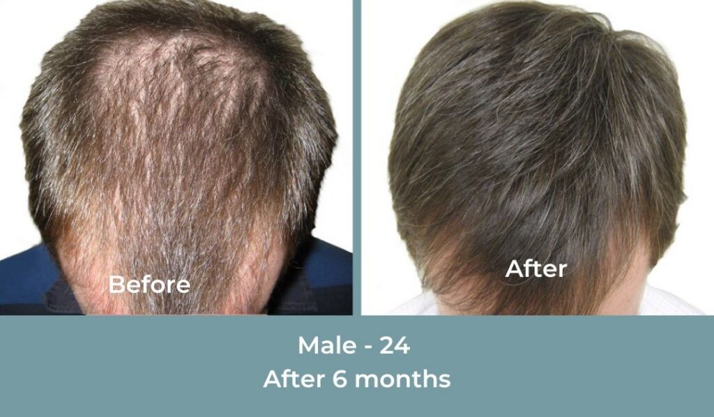 Facebook Ads 1080x1080 GetHairMd - 85
