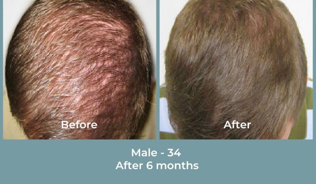 Facebook Ads 1080x1080 GetHairMd - 84