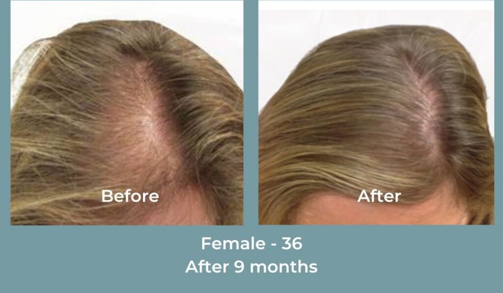 Facebook Ads 1080x1080 GetHairMd - 102