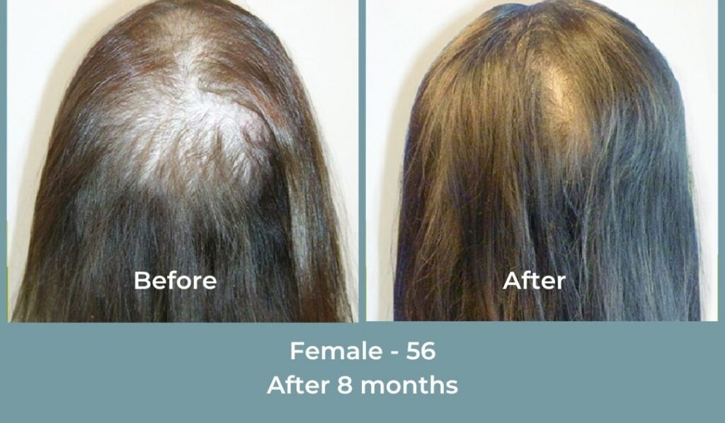Facebook Ads 1080x1080 GetHairMd - 101