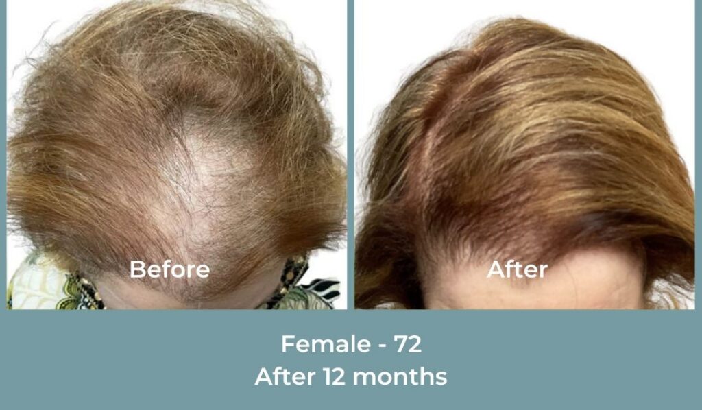 Facebook Ads 1080x1080 GetHairMd - 98