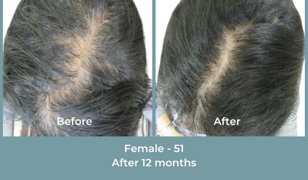 Facebook Ads 1080x1080 GetHairMd - 97