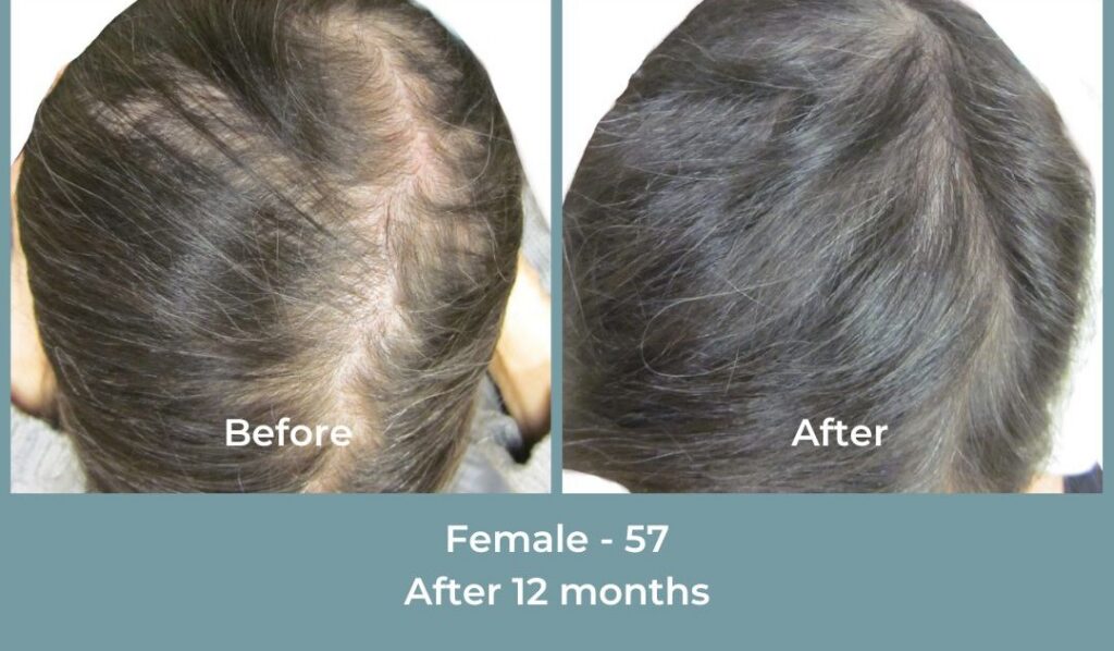 Facebook Ads 1080x1080 GetHairMd - 95