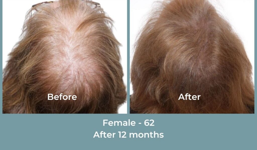 Facebook Ads 1080x1080 GetHairMd - 94