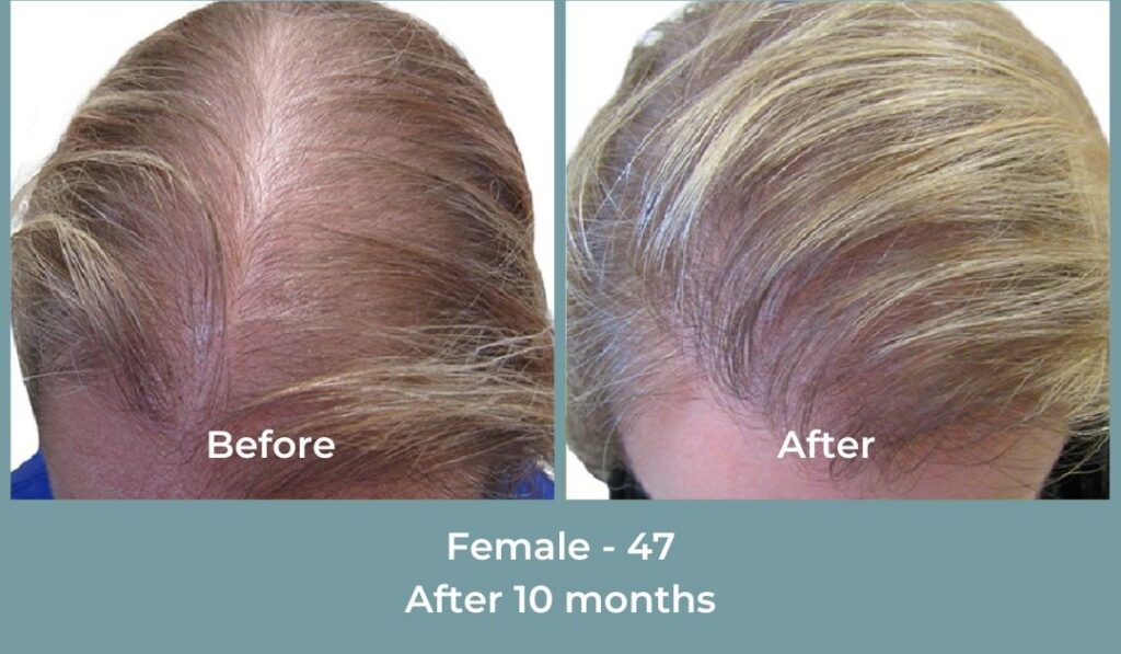 Facebook Ads 1080x1080 GetHairMd - 93