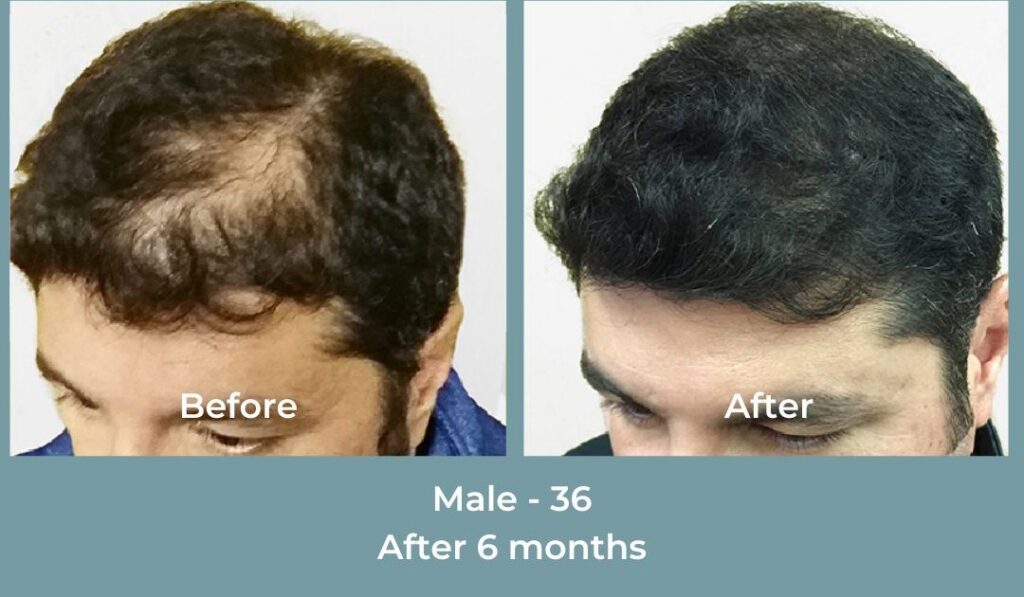 Facebook Ads 1080x1080 GetHairMd - 92