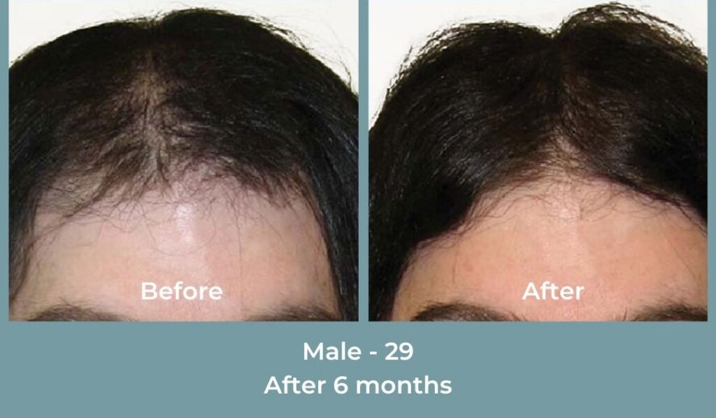 Facebook Ads 1080x1080 GetHairMd - 90
