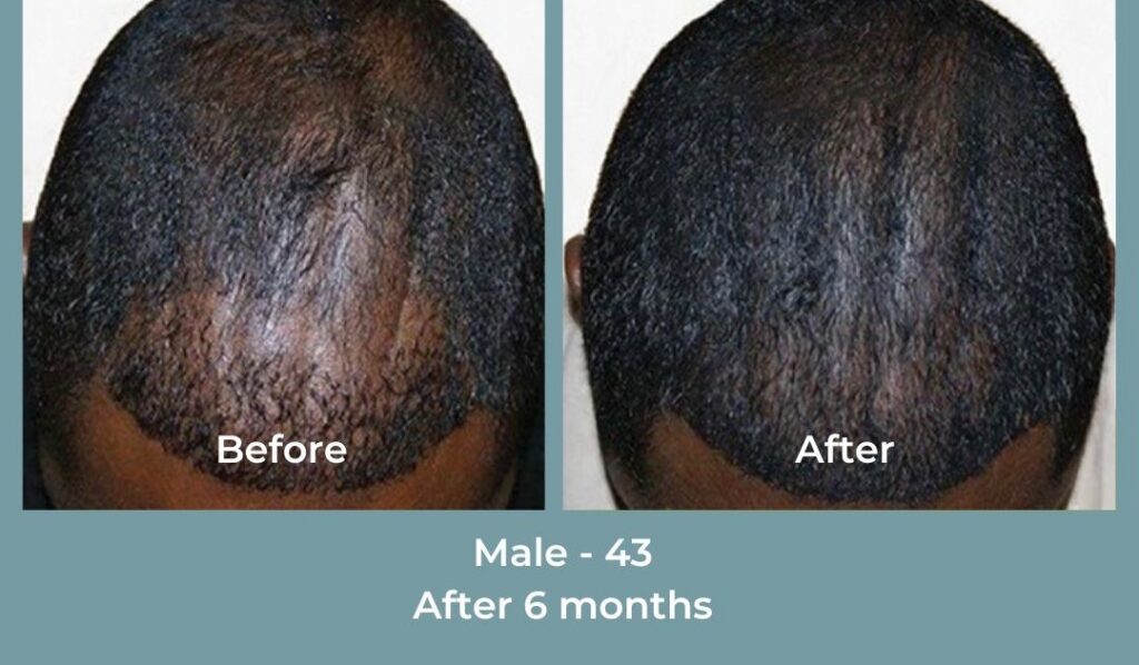 Facebook Ads 1080x1080 GetHairMd - 89
