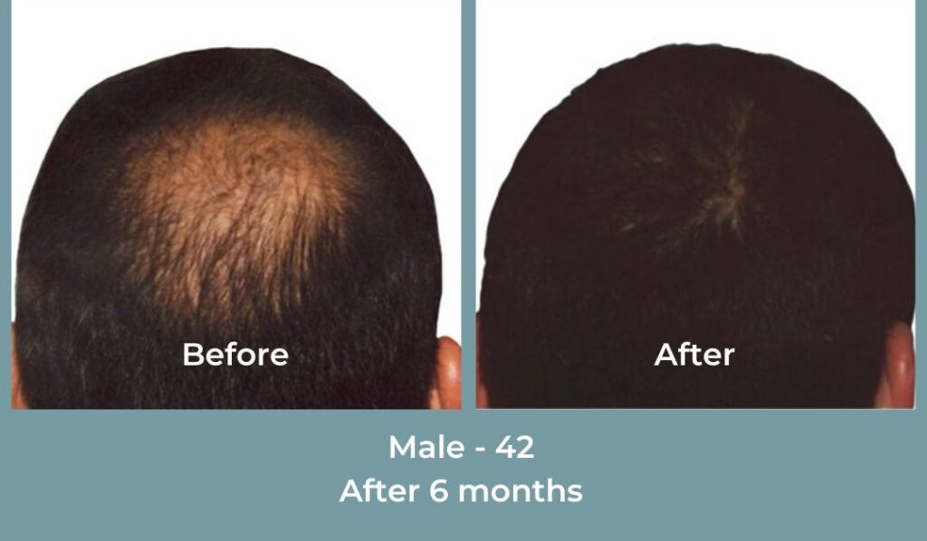 Facebook Ads 1080x1080 GetHairMd - 88